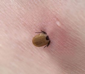 Tick embedded on the stomach